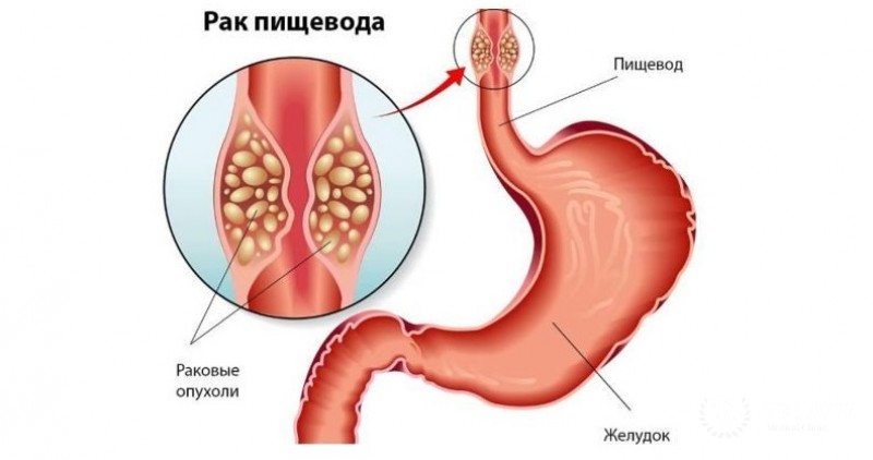 Рак пищевода