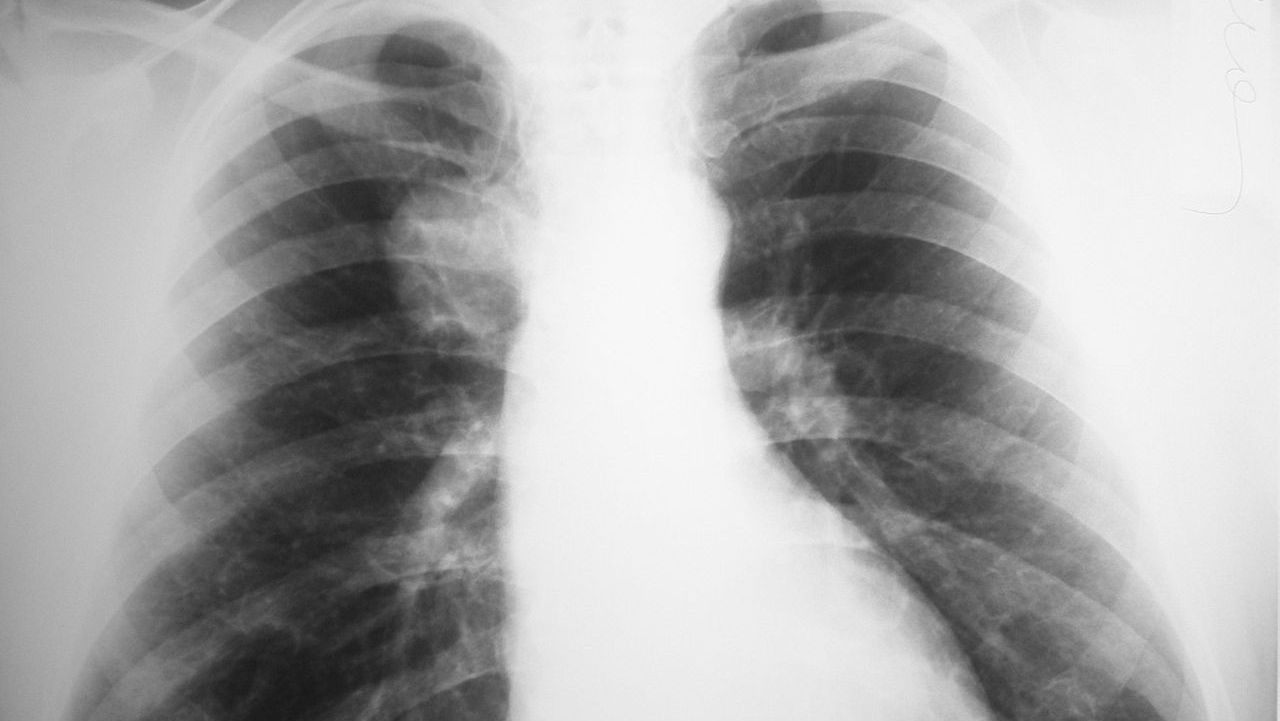 Рентген легких