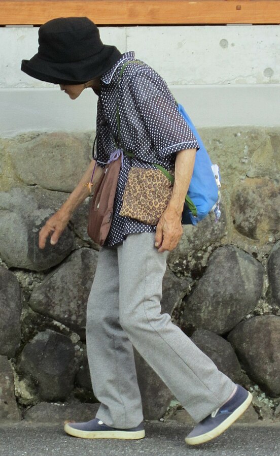 Пожилая японская женщина, больная остеопорозом