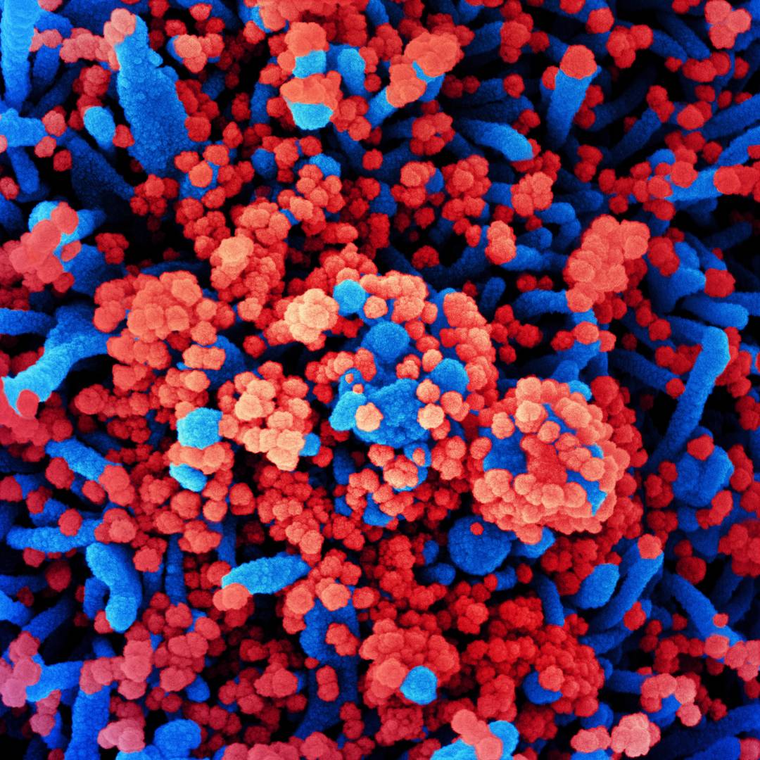 Вирусные частицы SARS-CoV-2, в огромном количестве атаковавшие клетку. Фотоизображение с электронного микроскопа