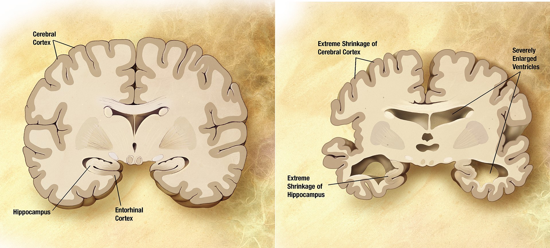 Изображение нормального мозга и мозга при болезни Альцгеймера