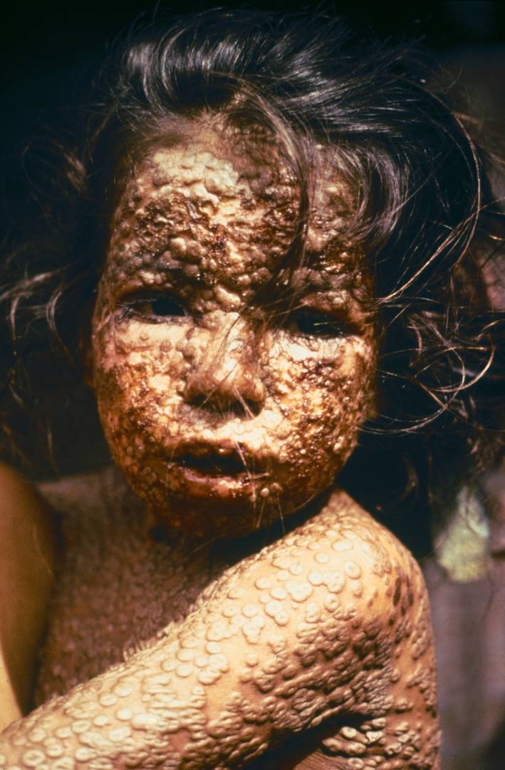 Девочка из Бангладеш, больная натуральной оспой. 1973