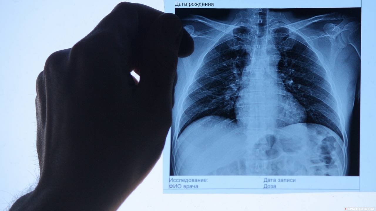 Более 390 случаев заражения туберкулёзом зафиксировано в Забайкалье
