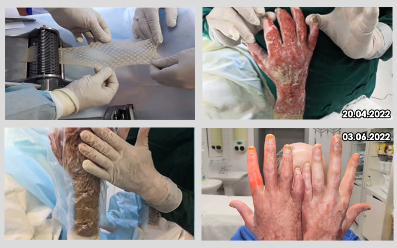 Результат пересадки кожи по технологии Василия Мензула