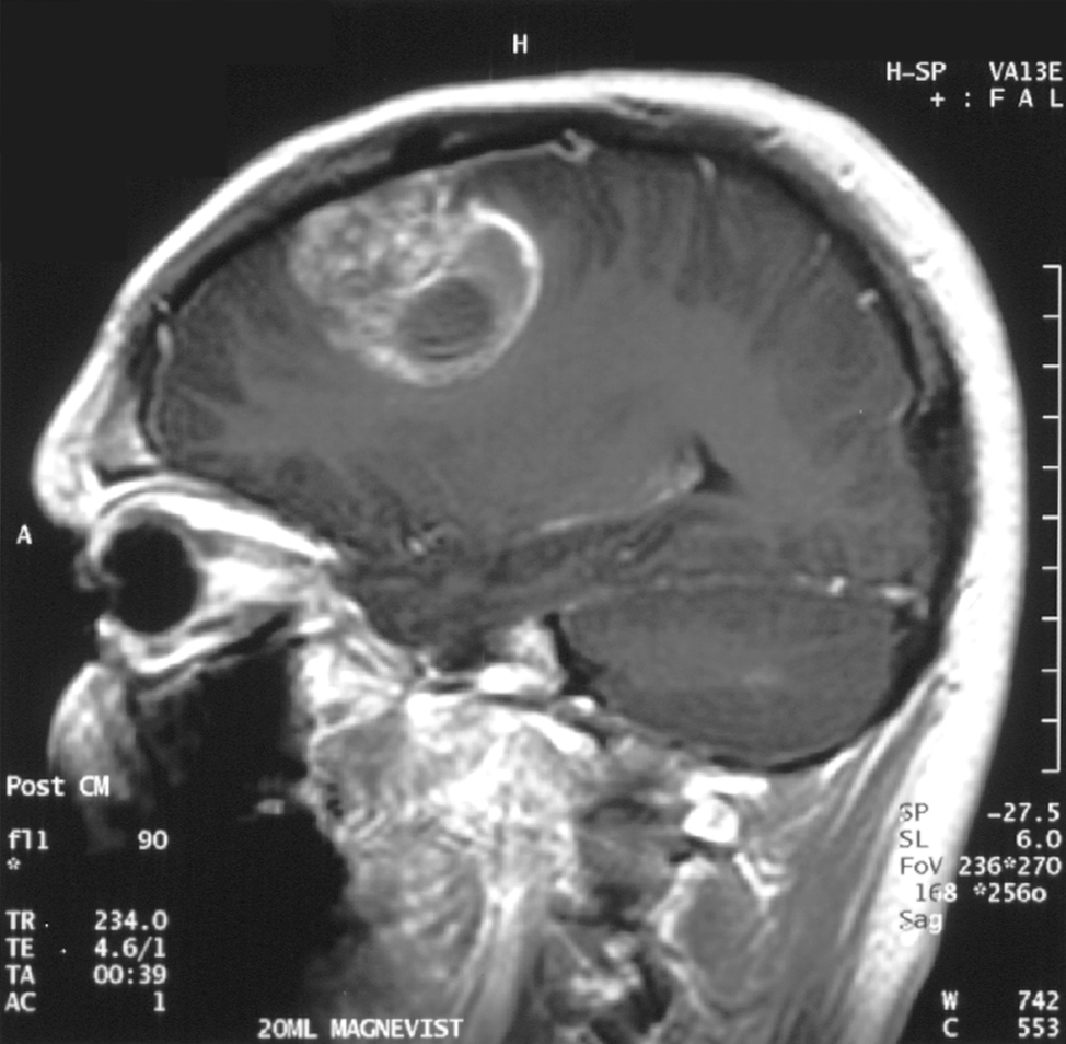 Глиобластома (опухоль головного мозга) на МРТ