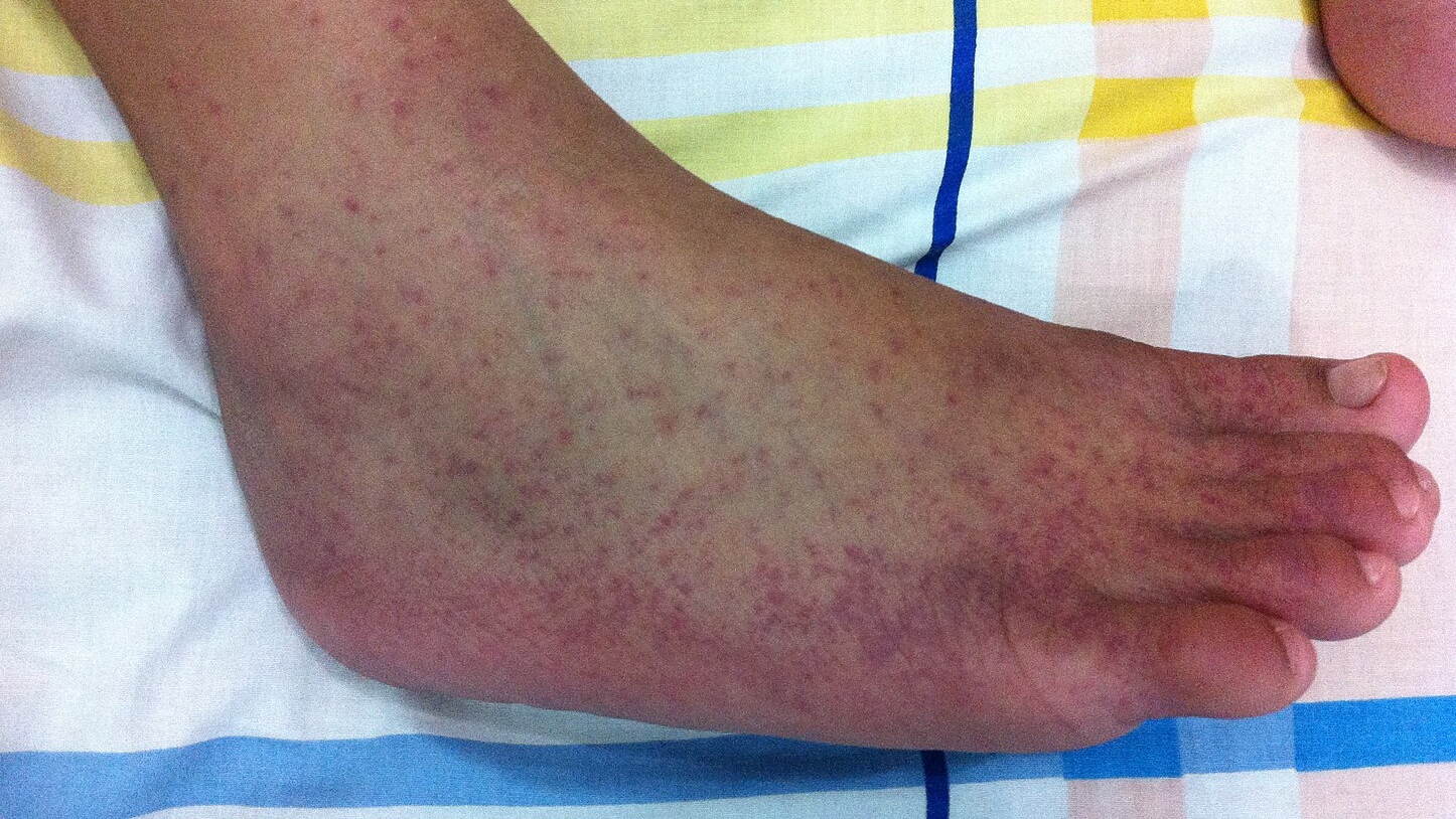 Лихорадка. Сыпь от чикунгуньи.