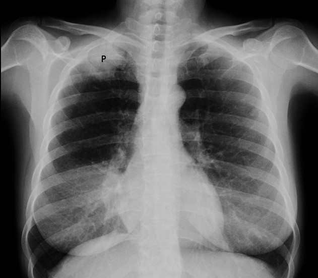 Рентгенограмма органов грудной клетки, опухоль Панкоста (обозначена P, немелкоклеточная карцинома правого лёгкого) у курящей женщины 47 лет.