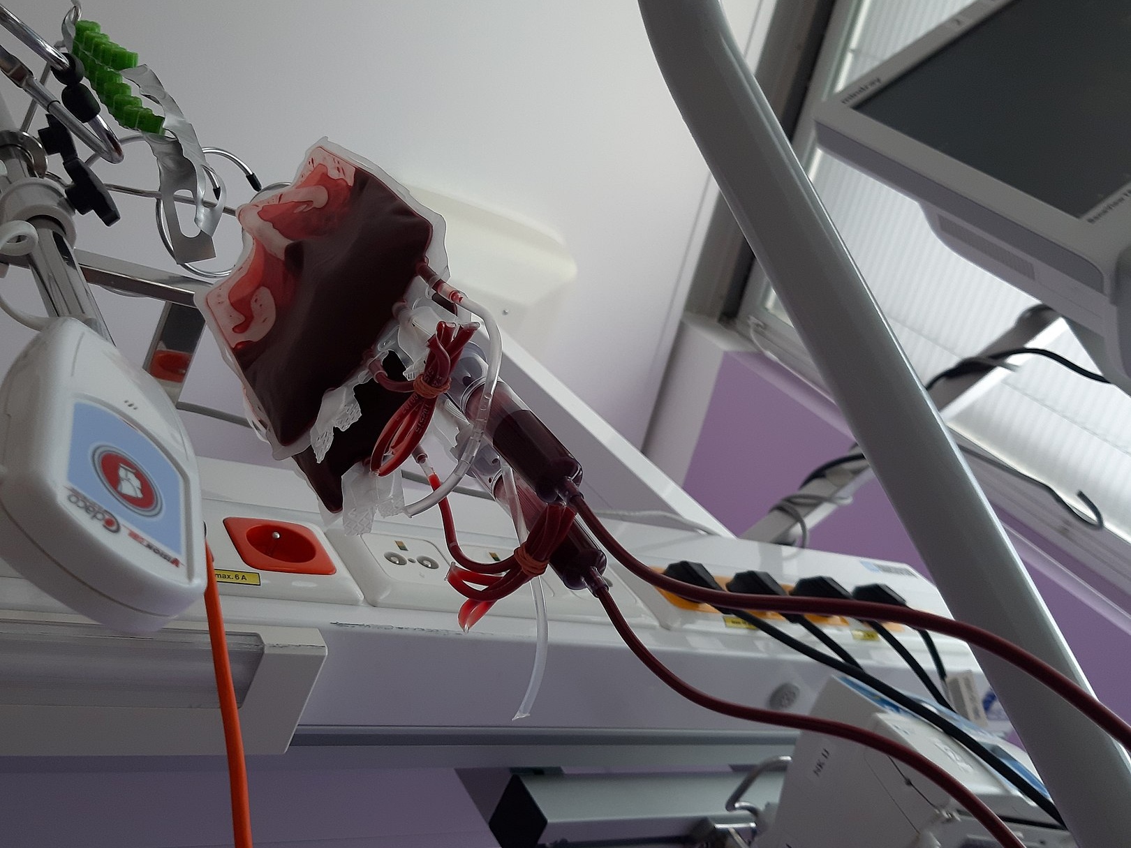 Контейнер с кровью во время переливания.