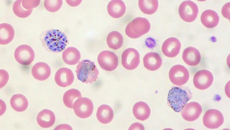 Клетки крови, пораженные малярией