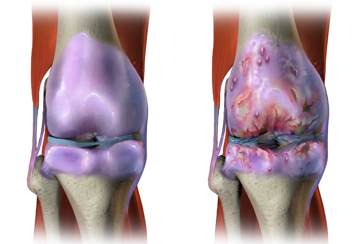 Слева изображение здорового сустава, справа — пораженного остеоартритом